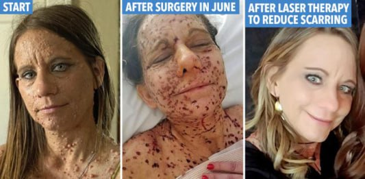 Mum cruelly branded a ‘toad’ due to thousands of tumors covering her body reveals dramatic transformation after undergoing surgery